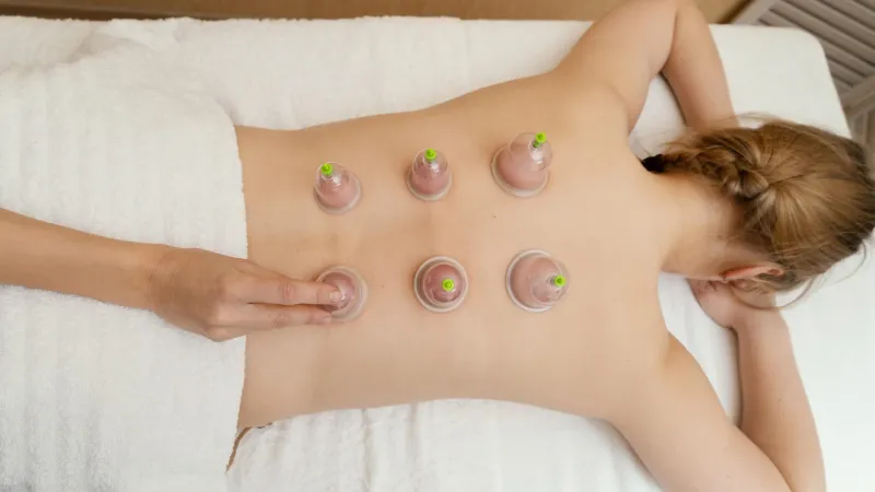 Cupping Therapy