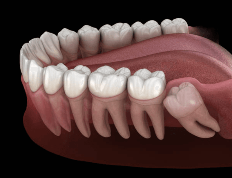 Wisdom Teeth Are Evolutionary Leftovers