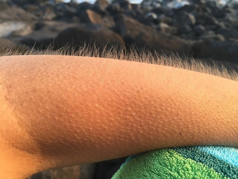Goosebumps Are a Primate Inheritance