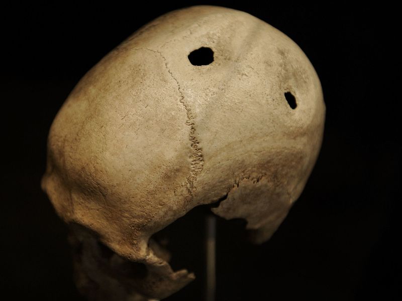 Incan Brain Surgery (Andes, ~1000 CE)