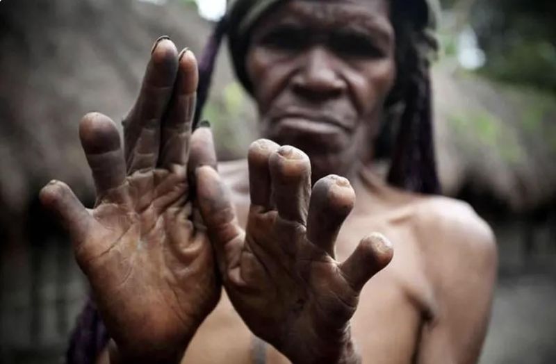 Finger Cutting of the Dani Tribe (Indonesia/Papua New Guinea)