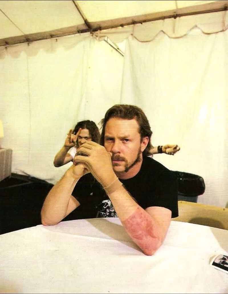 James Hetfield Burned by Pyro (1992)