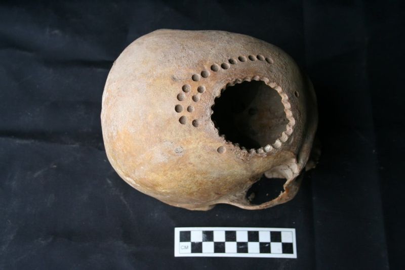 Brain Drain Surgery (Peru, ~600 CE)