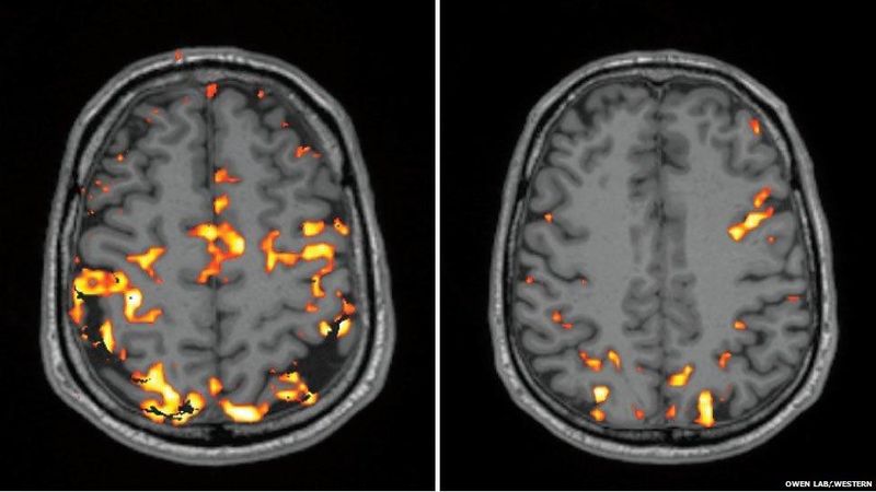 Sleep Deprivation Harms Brain Health
