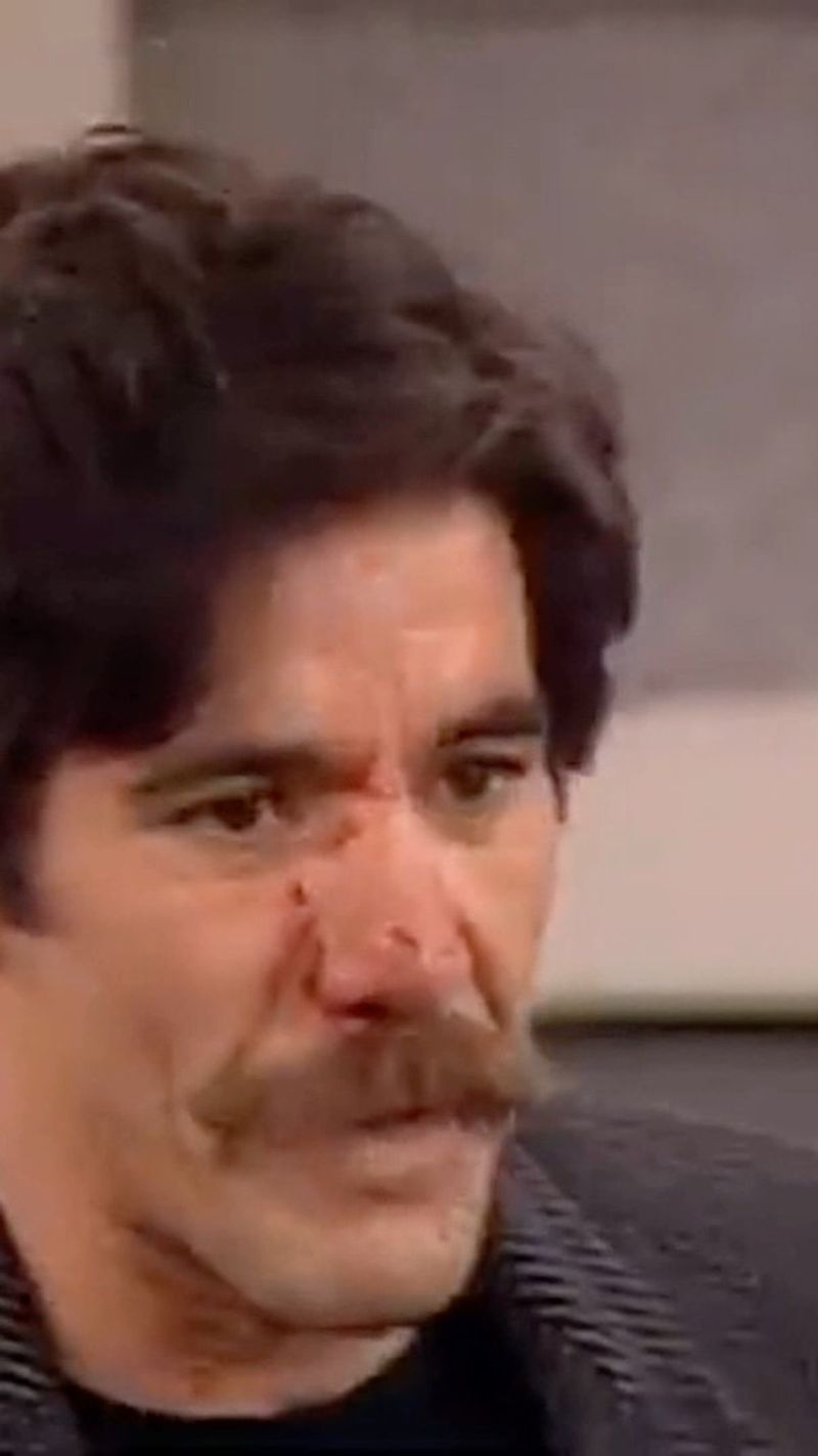Geraldo's Broken Nose Broadcast