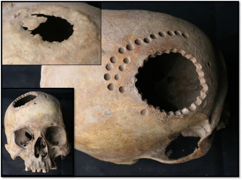 Trepanation (Skull Drilling)