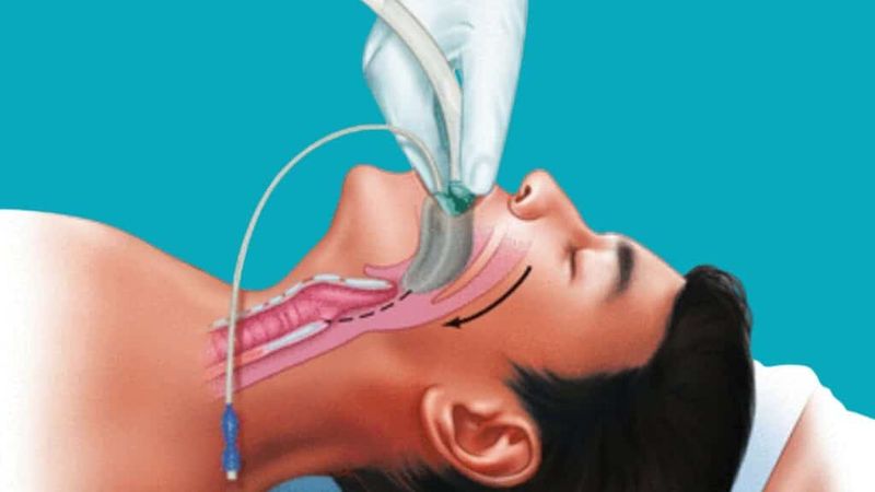 Laryngeal Mask Airway Improves Surgery Safety