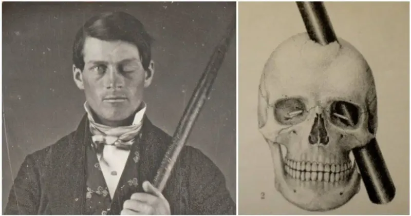 Phineas Gage (1823–1860)