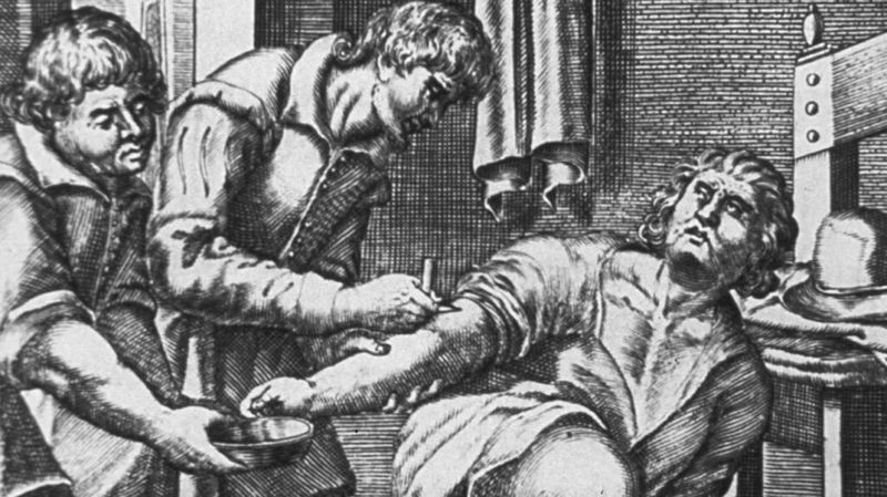 Bloodletting for Fevers