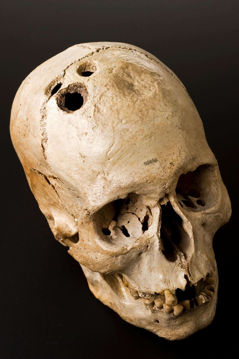 Inca Surgeons Performed Skull Surgeries Better Than Their European Counterparts